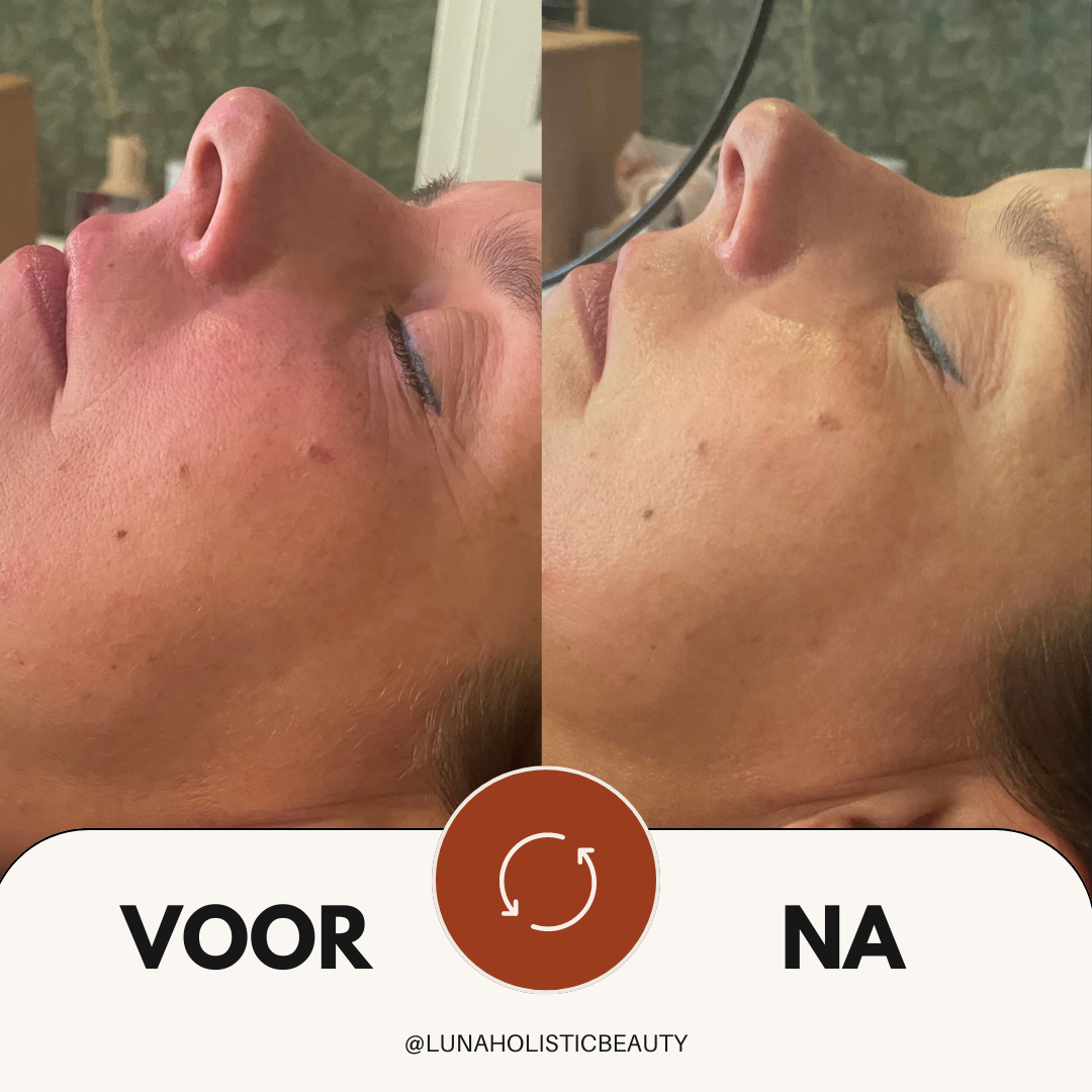 Voor en na foto schoonheidsbehandeling
